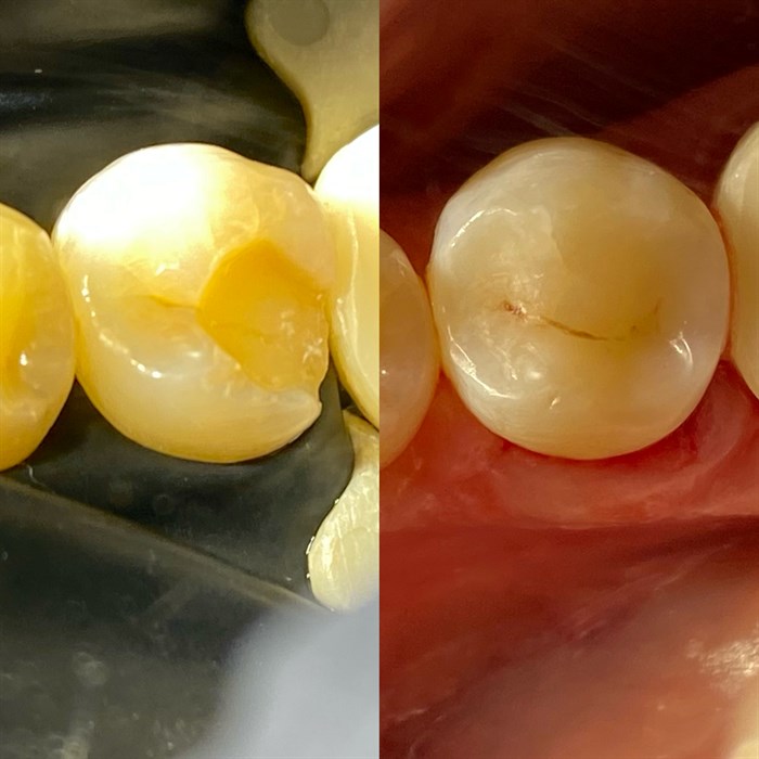 Обзор и оценка профессионального использования Пломбировочного материала IGOS стоматологами